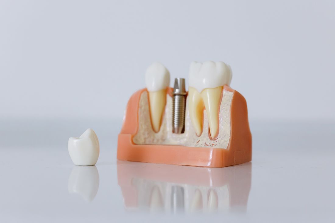 Educational model showing a dental implant and a tooth-colored crown