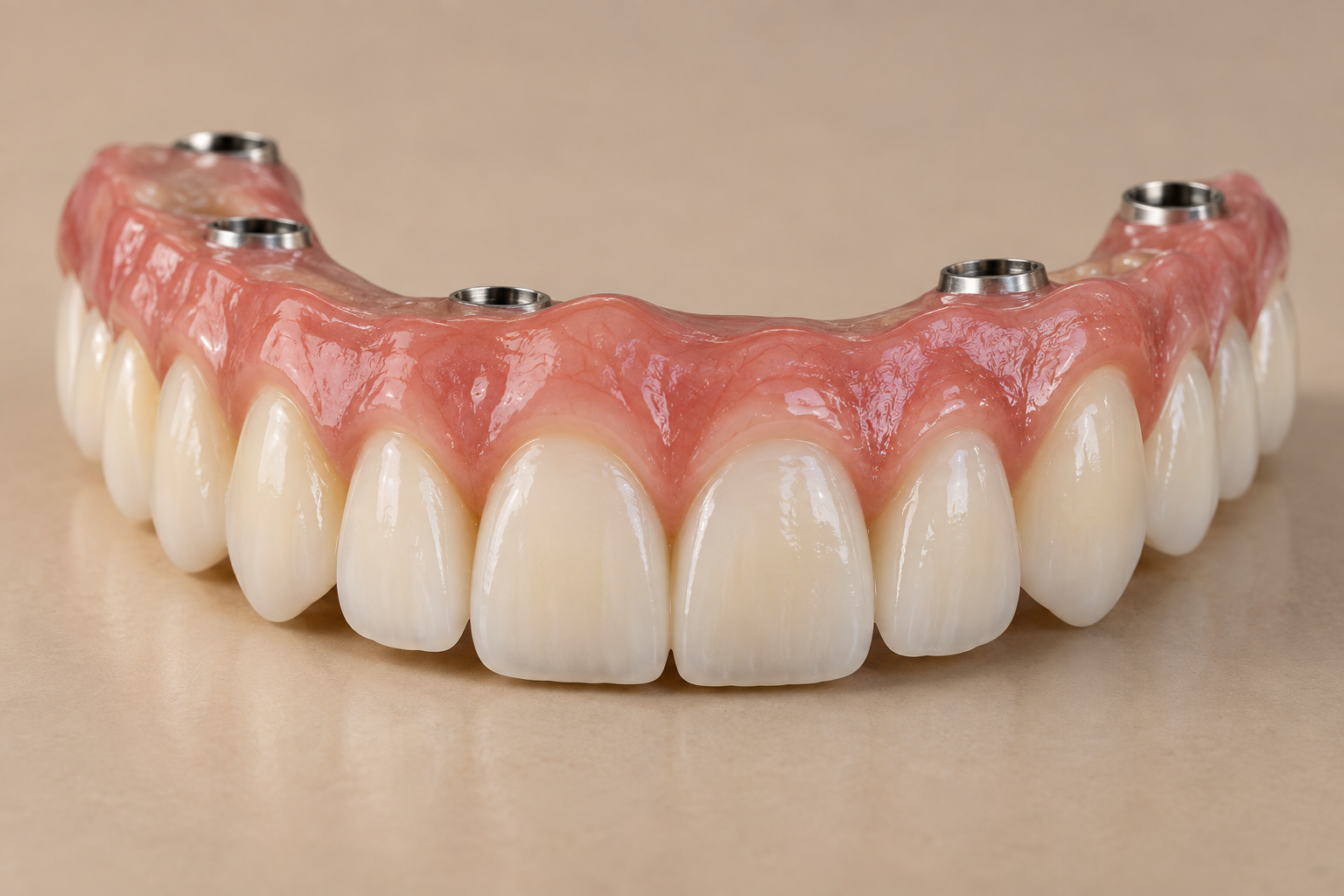 Illustrative full-arch implant prosthesis with white teeth and pink gingiva